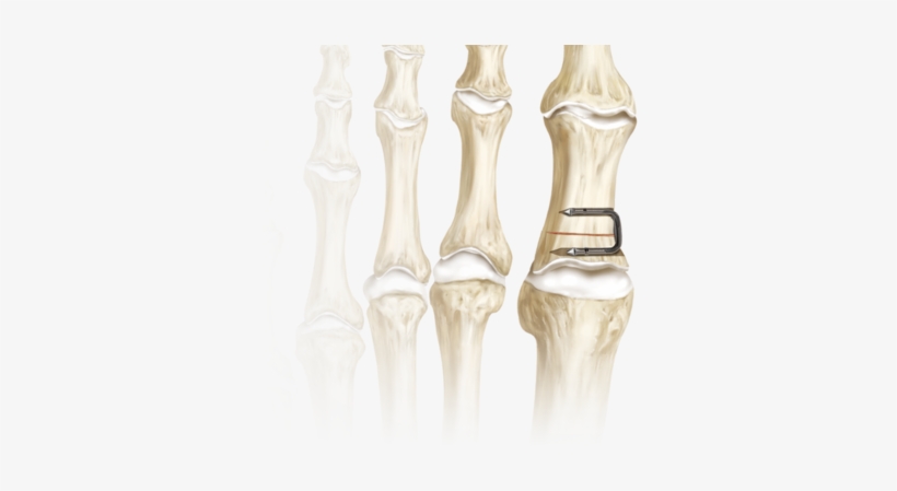 Quickfix Staple System 0 Large - Staple In Foot Bone Surgery, transparent png download