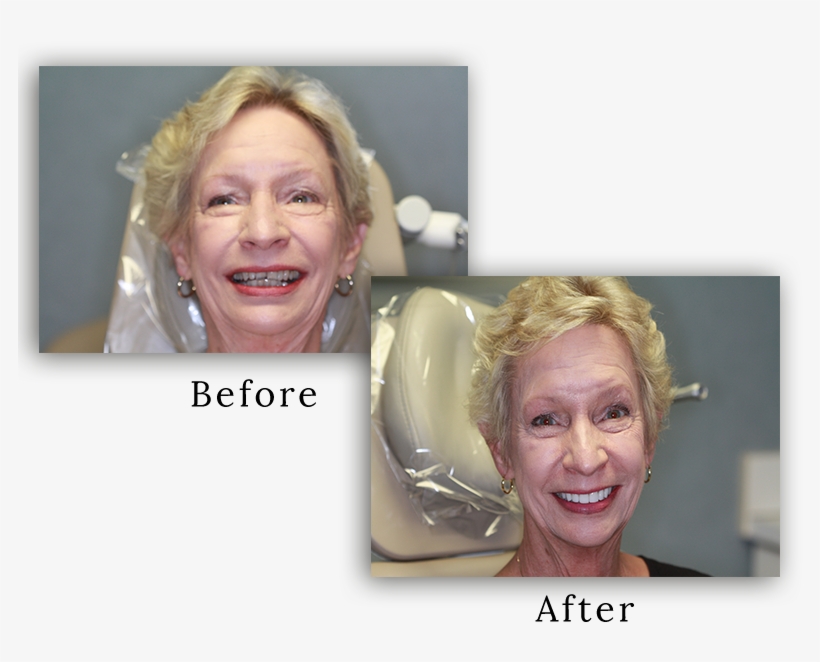 Dental Veneers Can Change Your Smile And Your Life - Senior Citizen, transparent png download
