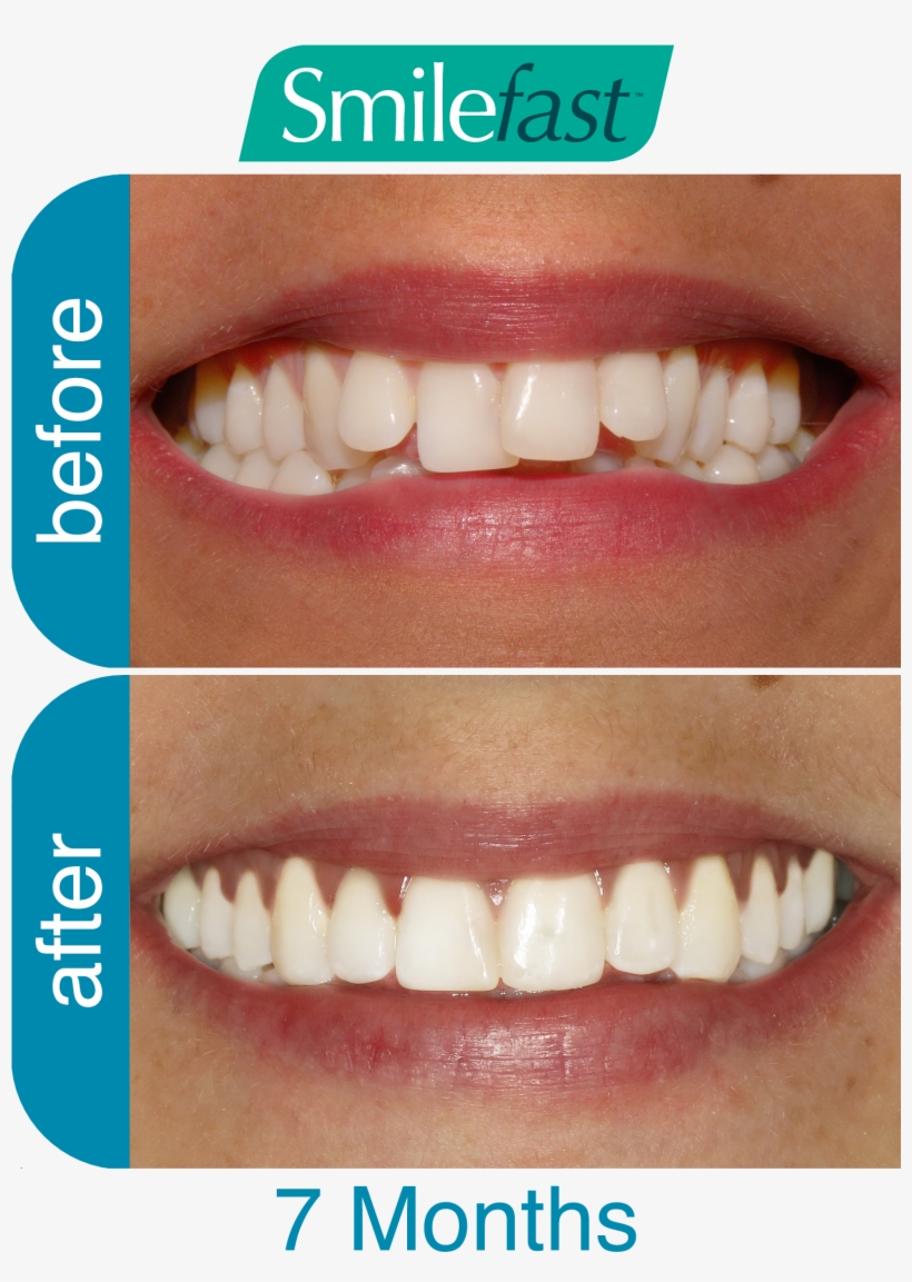 Aqd Smilefast After 7 Months2 Aqd Smilefast After 8 - Smilefast Before And After, transparent png download