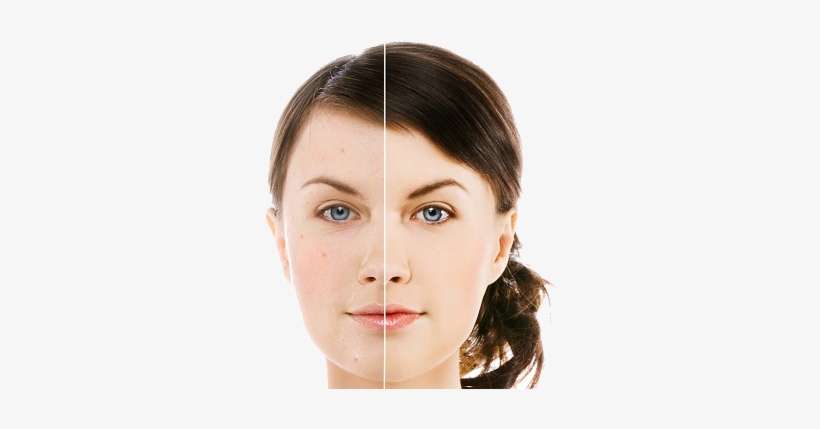 Tea Tree Oil Eyebrows Before And After, transparent png download