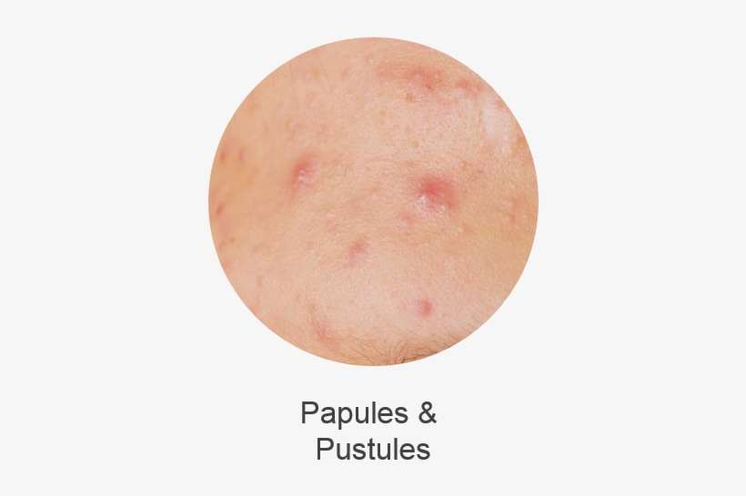 Is Associated With Pimples - Fruit, transparent png download