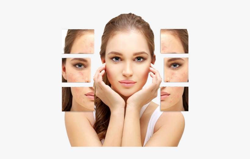 Acne Scars Removal For Women - Salicylic Acid Peel, transparent png download