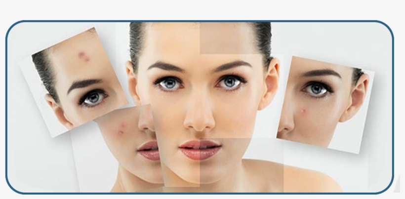 Acne - Imag1 - Salica Acne Face Wash And Cleanser With Salicylic Acid, transparent png download