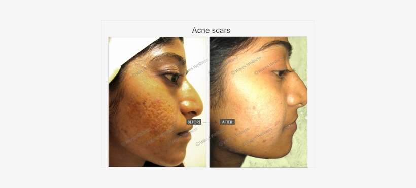 Scar, transparent png download