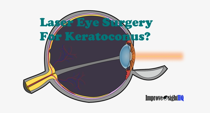 Laser Eye Surgery For Keratoconus - Keratoconus Treatment Laser, transparent png download
