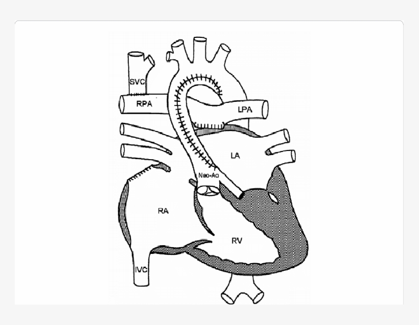 At The Time Of Bidirectional Glenn Procedure, The Gore-tex - Hypoplastic Left Heart Syndrome Mullins, transparent png download