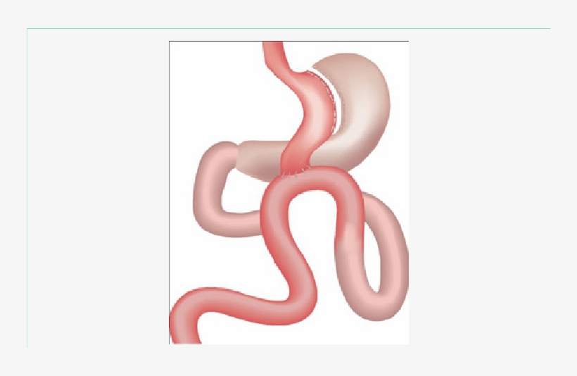 Mgb Created By Horizontal Division Distal To Crow's - Illustration, transparent png download