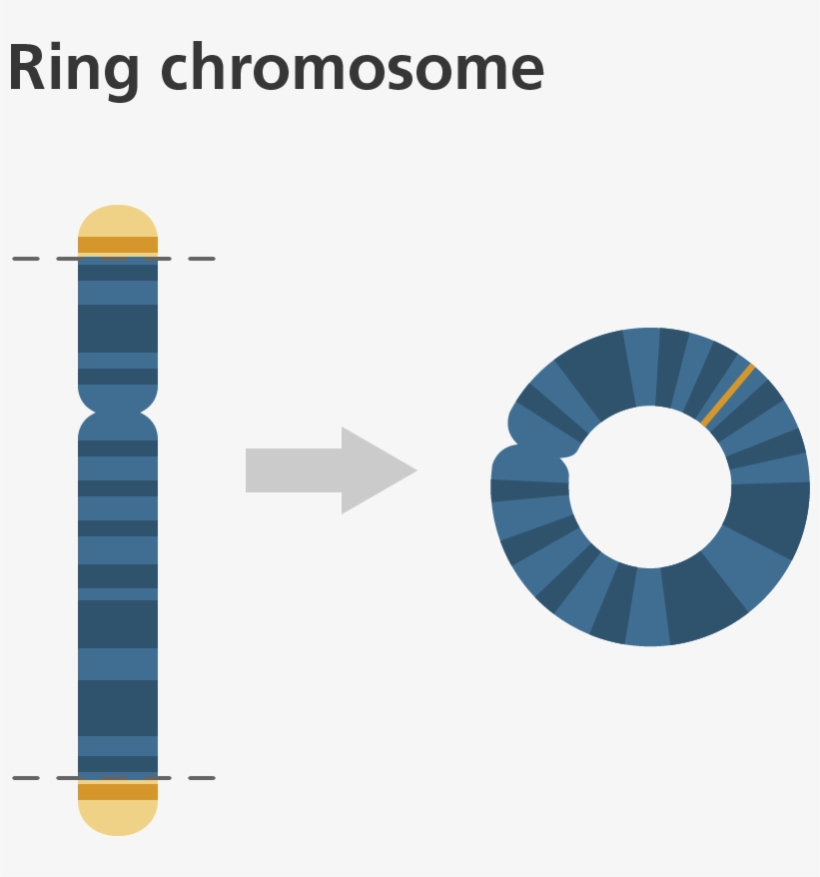 Balanced Vs Unbalanced Structural Abnormalities - Ring Chromosome, transparent png download