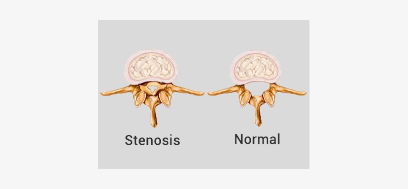 Spinal Stenosis - Spinal Stenosis Before And After, transparent png download