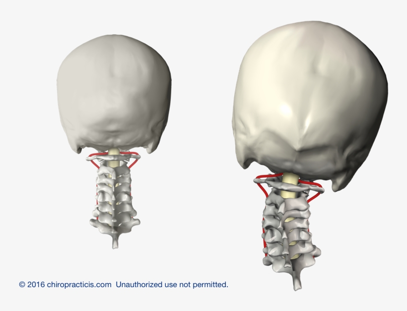 Vertebral Subluxation Newburyport Chiropractor - Subluxated Spine, transparent png download