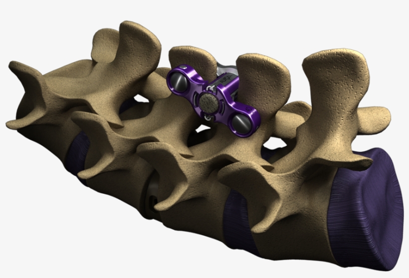 Spine Zipultra-1 - Interspinous Fusion Device, transparent png download