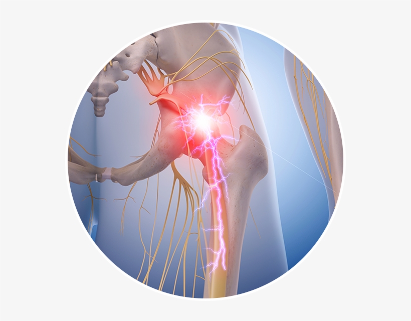 Therefore, When Something Goes Wrong During A Lumbar - Sciatic Nerve Pain, transparent png download