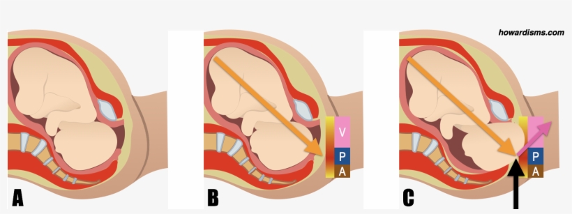 In The Illustration Above, We See In A A Baby Just - Perineal Trauma, transparent png download