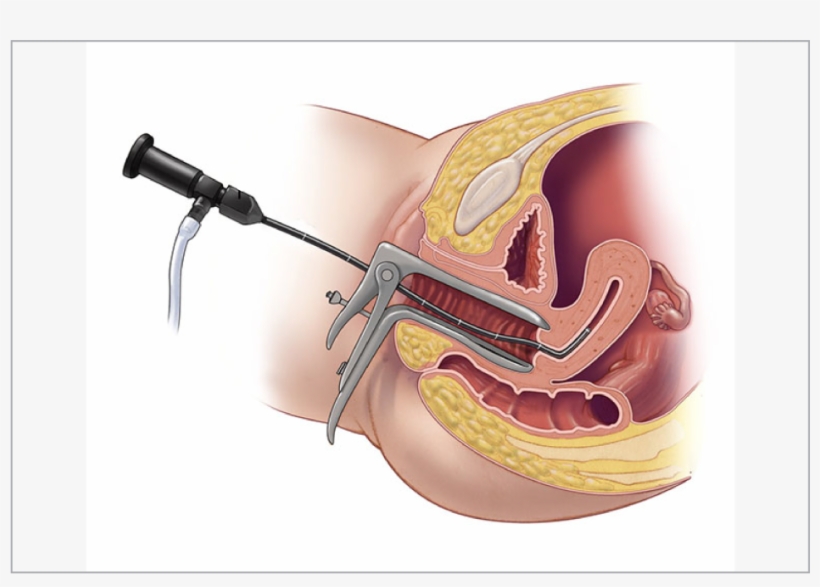Endometrium Cavity, transparent png download