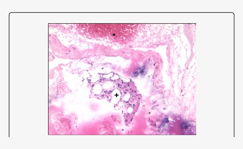 Histological View Of A Ruptured Achilles Tendon - Red Blood Cell, transparent png download
