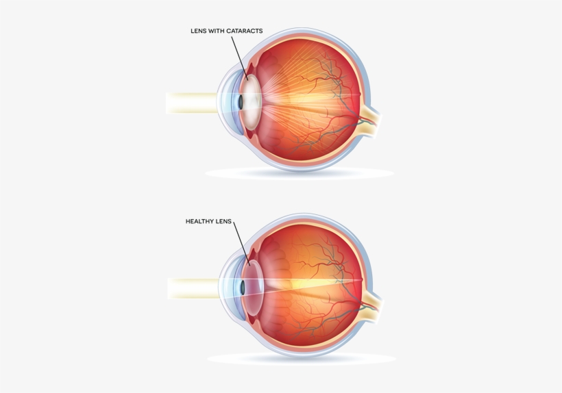 A Cataract Is The Clouding Of The Crystalline Lens - Cloudy Vision In One Eye, transparent png download