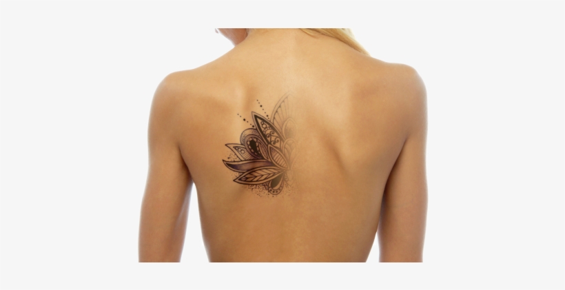 Tattoo-removal - Npm Tattoo Removal, transparent png download