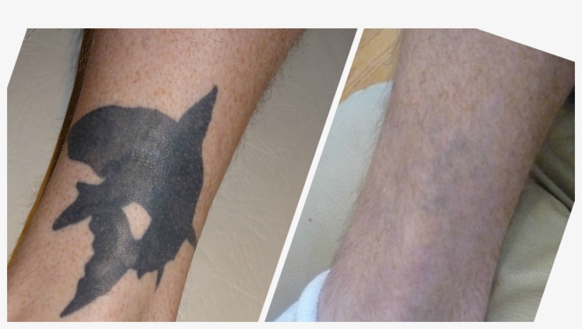 Lasers Work By Producing Short Pulses Of Intense Light - Laser Tattoo Fading, transparent png download