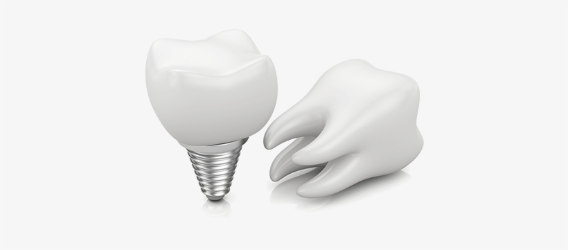 Dental Implants - Dental Implant, transparent png download