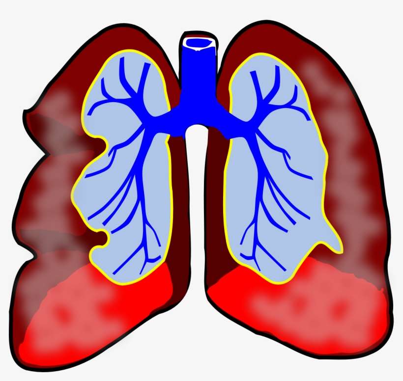 Association Of Secondhand Smoke Exposure With Asthma - Asthma Cure! : The Ultimate Guide To Manage Asthma, transparent png download