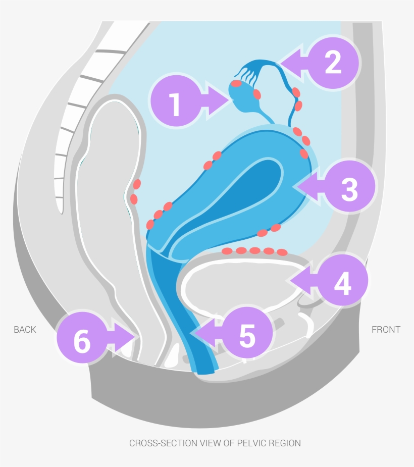 Treatment For Endometriosis - Illustration, transparent png download