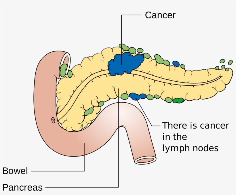 Source - Criticalhealthfacts - Com - Linfonodi Pancreas, transparent png download