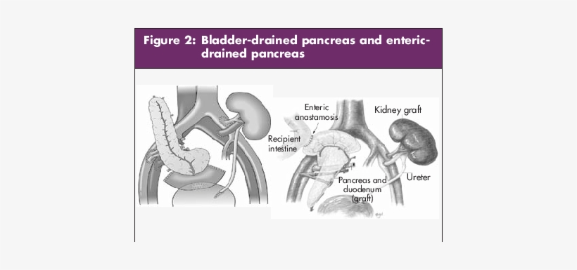 Bladder-drained Pancreas And Entericdrained Pancreas - Type 1 Diabetes, transparent png download