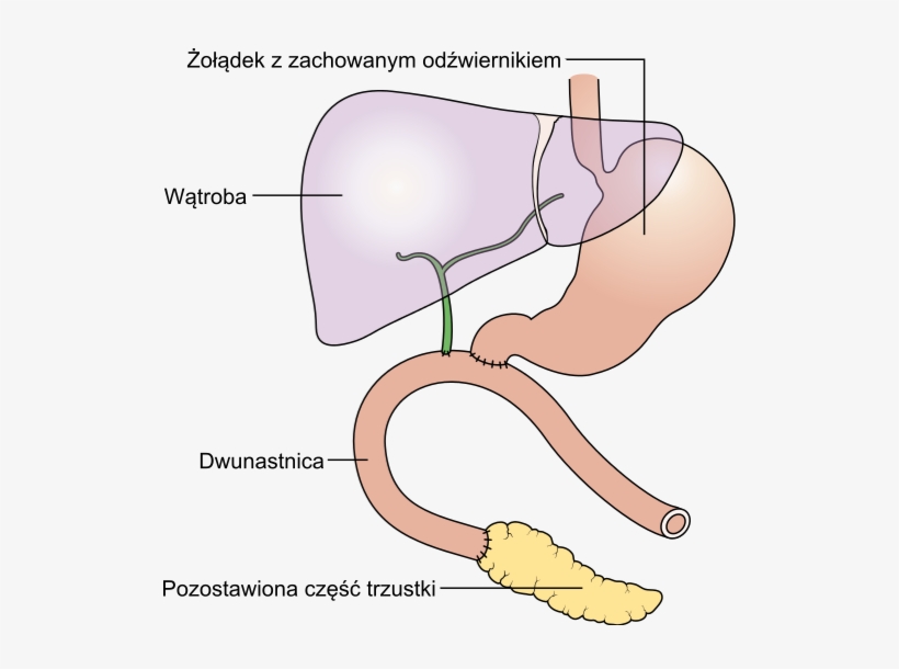 Diagram Showing The Pancreas Joined To The Small Bowel - Traverso Pancreas, transparent png download