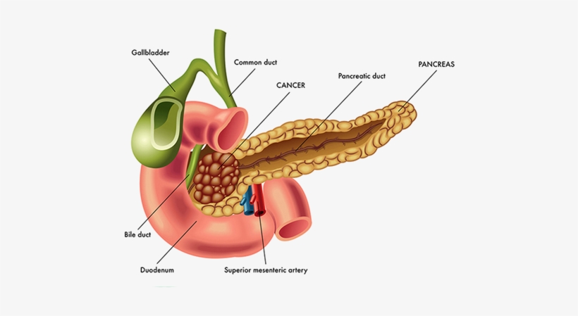 Ductal Adenocarcinoma Is By Far The Most Common Type - Pancreatic Cancer, transparent png download