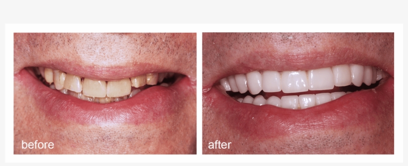 Shot Of Before And After Visiting Abington Smile Gallery - Aggression, transparent png download