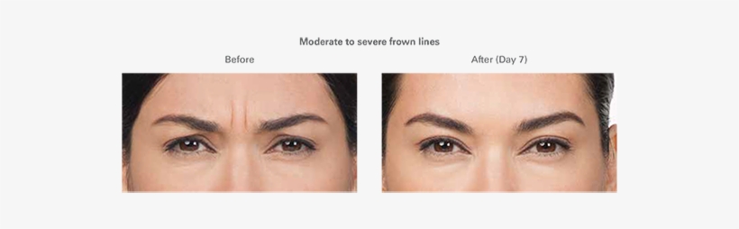 Ardmore Botox - Cosmetics, transparent png download