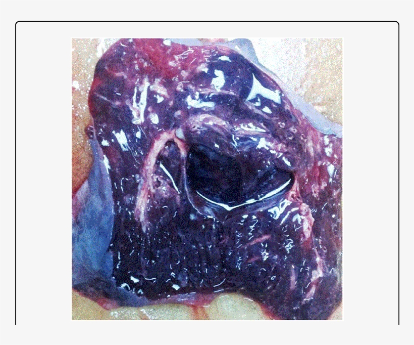 Extensive Pulmonary Hemorrhage - Fatal Pulmonary Hemorrhage Lung Cancer, transparent png download