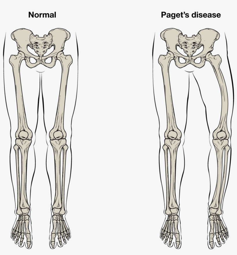 This Illustration Shows The Normal Skeletal Structure - Paget's Disease Of Bone, transparent png download