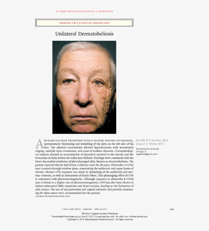 Shocking Proof Of The Effects Of Sun On Aging - Bill Mcelligot, transparent png download