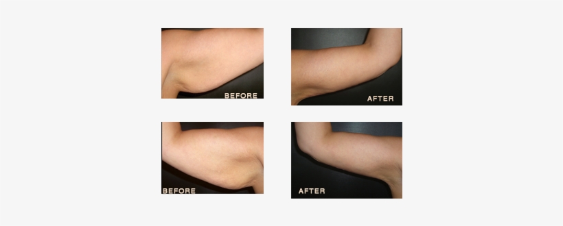 Arm34 - Arm Lift 6 Month Post Op, transparent png download