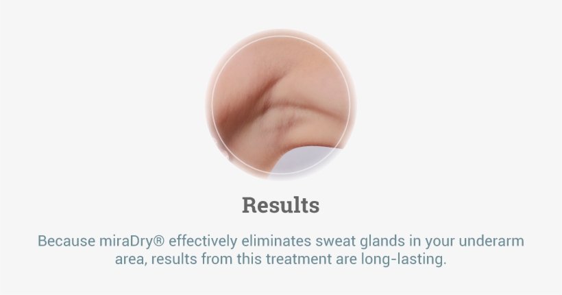 Miradry® Results - Retail Adventures, transparent png download