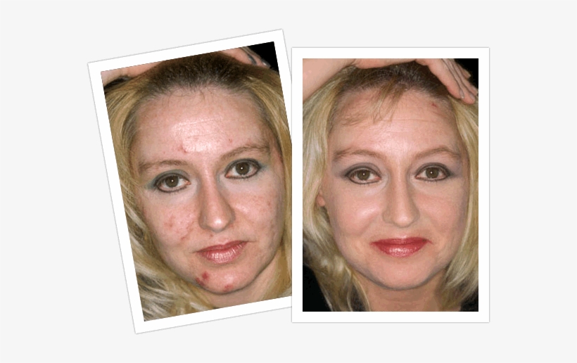 Adult Acne Before And After Laser Treatment Laser Treatment For Acne