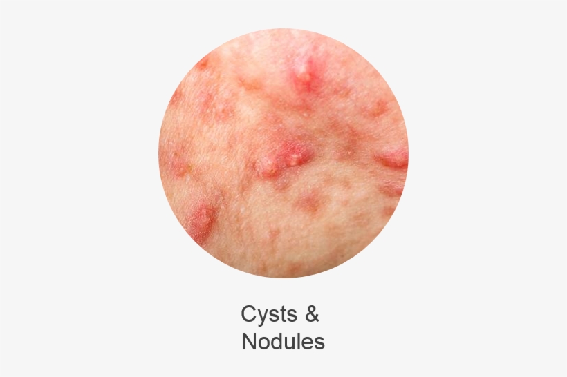 Comprises Blackheads Or Whiteheads Which Result From - Pluot, transparent png download
