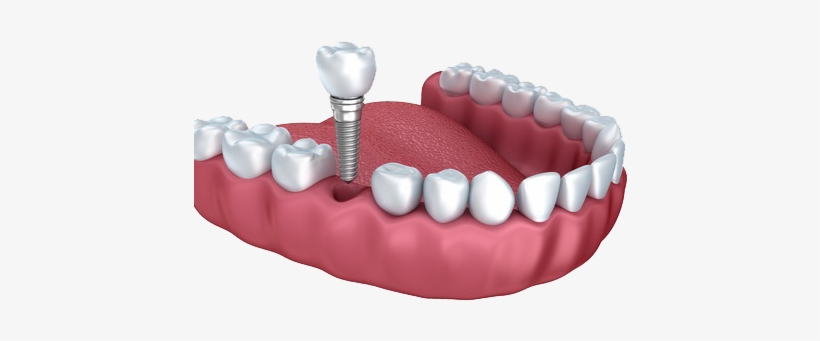 Why Patients Choose Dental Implants Over Dental Bridges - Denture Implant, transparent png download