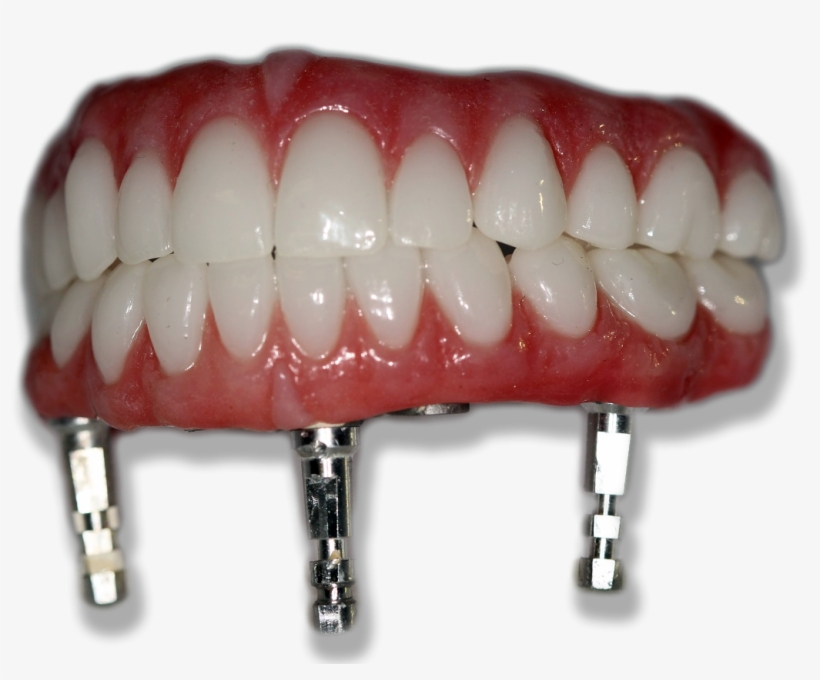 New Teeth In Just One Day - White Wolf Dental Group, transparent png download