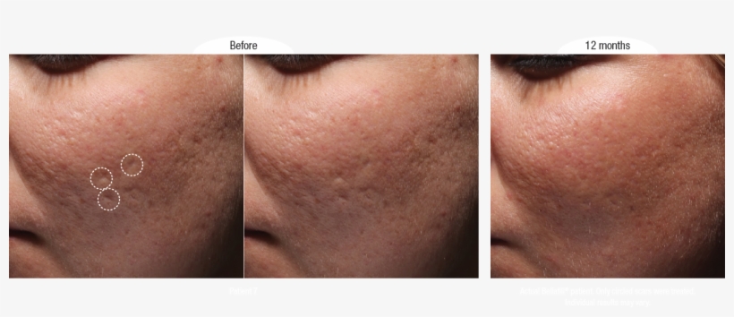 Bellafill Acne Scar Filler Photoset - Well Medical Arts, transparent png download