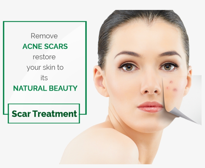 Laser Acne Scars Removal Treatment Beauty Mole Removal Sweep Spot Pen