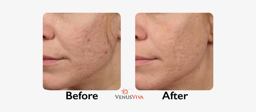 Before & After - Venus Viva 2018 Before And After, transparent png download