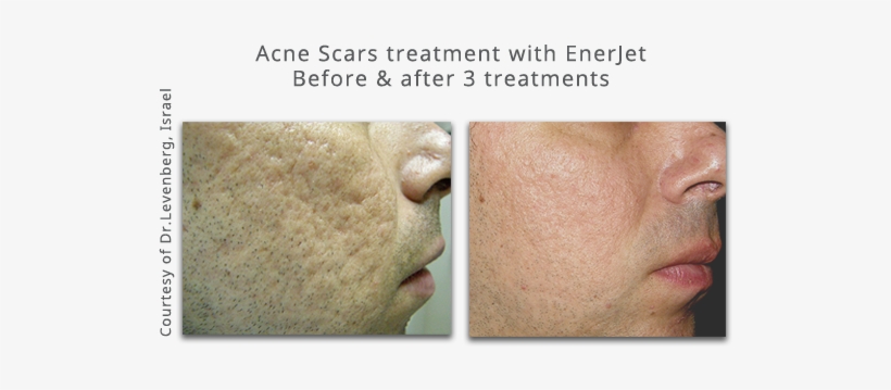 Click Here To Read More About - Enerjet Before And After, transparent png download