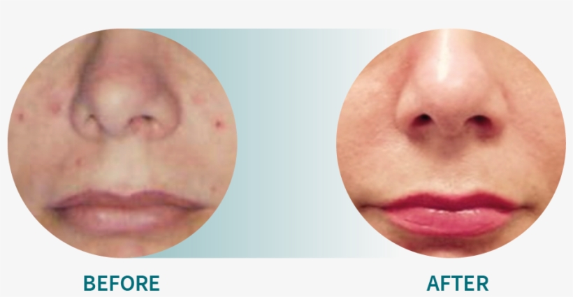 Indication - Acne - Advalight Aps, transparent png download