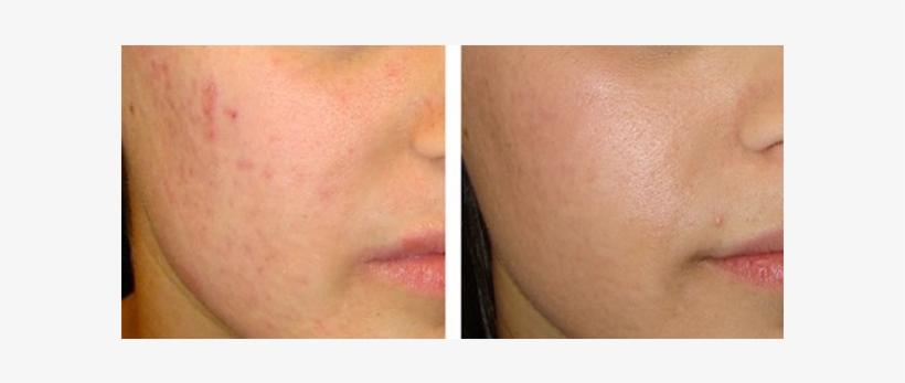 With A Laser, Scars Can Be Lessened Significantly And - Scar, transparent png download