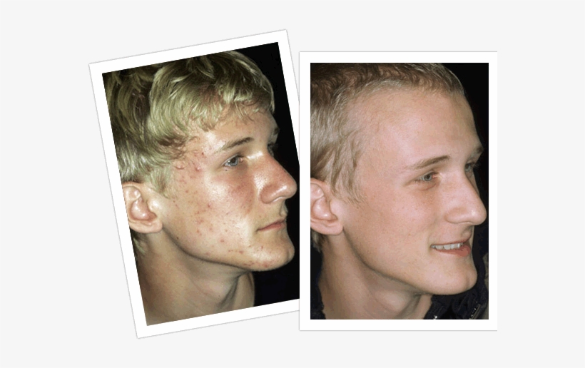 Teenage Acne Before And After Laser Acne Treatment - Acne Scars On Teens, transparent png download