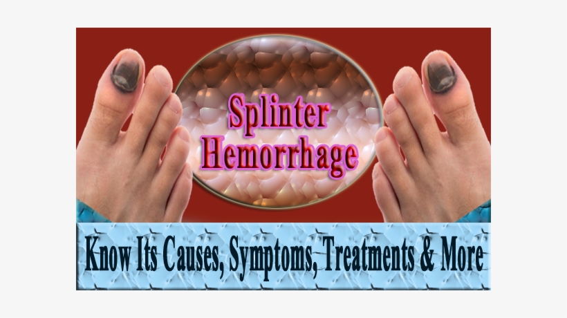 Splinter Hemorrhages Causes, transparent png download