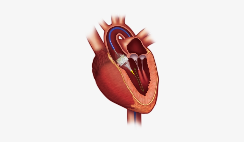 The Patient's Aortic Valve Is Replaced Using A Minimally-invasive - Tavr Medical, transparent png download