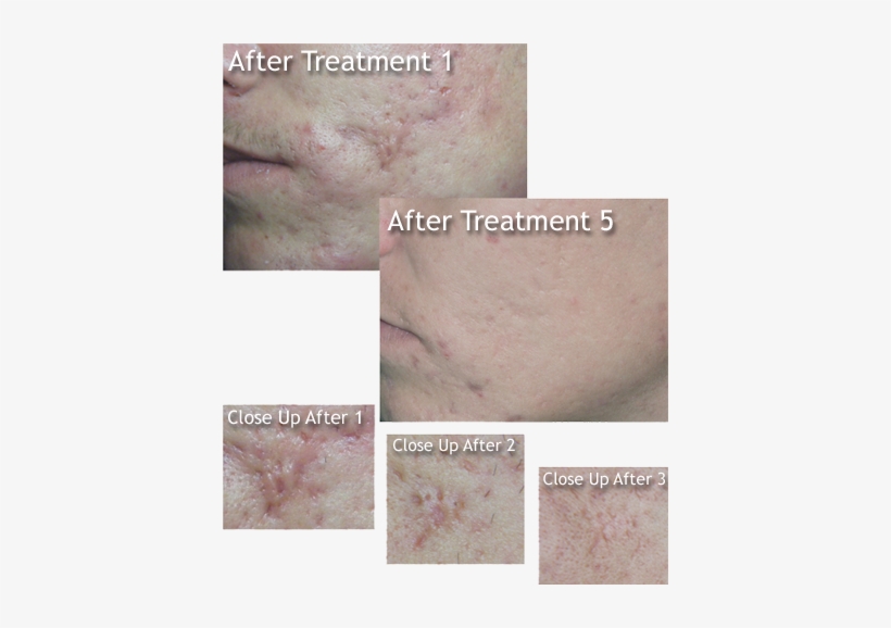 Are You Tired Of Trying Expensive And In Effective - Dermaplaning On Acne Scars, transparent png download